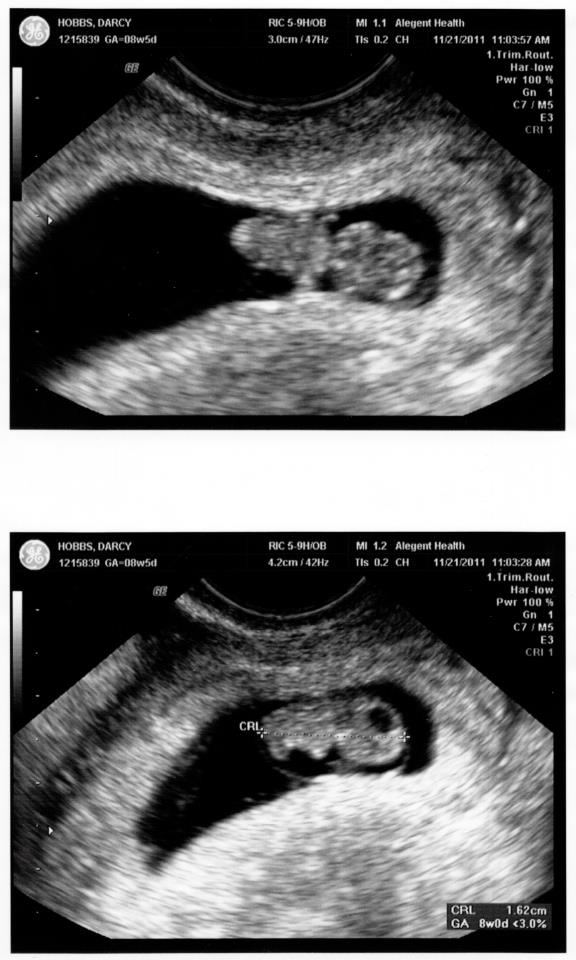 Baby Hobbs Ultrasound